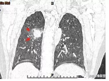 【病例】肺结核性空洞1例CT影像讨论分析 【病例】肺结核性空洞1例CT影像讨论分析
