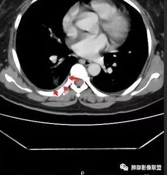 【病例】肺结核性空洞1例CT影像讨论分析 【病例】肺结核性空洞1例CT影像讨论分析
