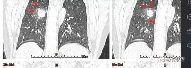 【病例】肺结核性空洞1例CT影像讨论分析 【病例】肺结核性空洞1例CT影像讨论分析