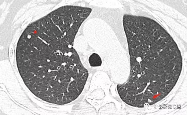 【病例】肺结核性空洞1例CT影像讨论分析 【病例】肺结核性空洞1例CT影像讨论分析