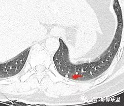 【病例】肺结核性空洞1例CT影像讨论分析 【病例】肺结核性空洞1例CT影像讨论分析