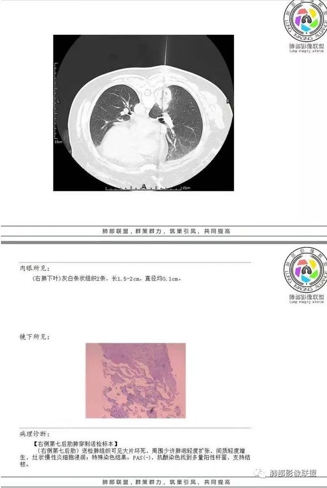 【病例】肺结核性空洞1例CT影像讨论分析 【病例】肺结核性空洞1例CT影像讨论分析