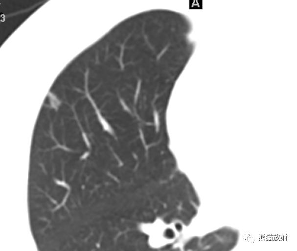 原发性肺黏液腺癌CT表现、病理基础 原发性肺黏液腺癌CT表现、病理基础