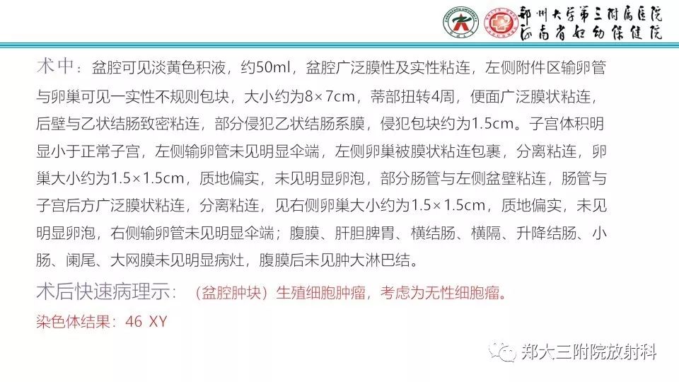 【病例】卵巢无性细胞瘤1例MR影像
