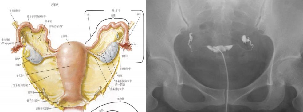女性盆腔附件解剖及其常见肿瘤的影像表现 女性盆腔附件解剖及其常见肿瘤的影像表现