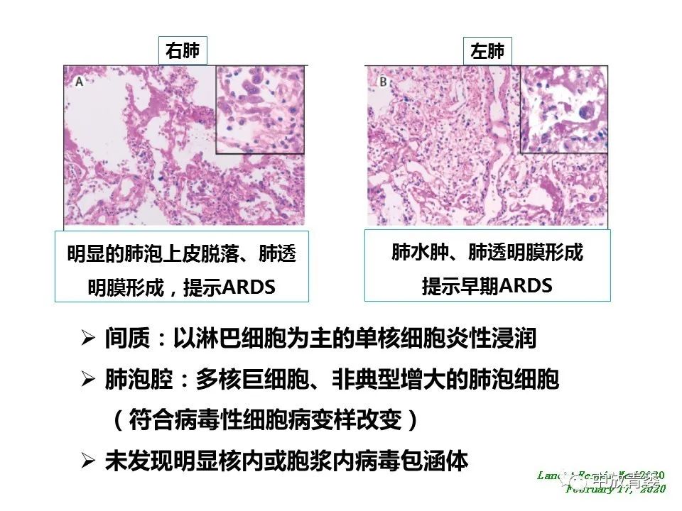 【PPT】COVID-19影像表现及研究进展