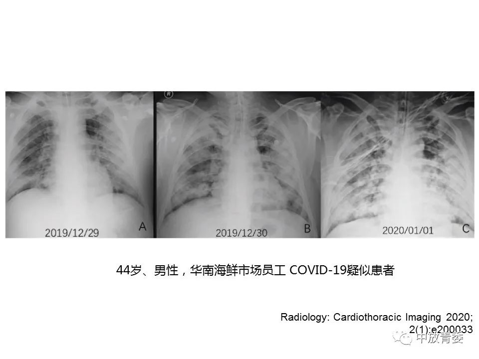 【PPT】COVID-19影像表现及研究进展