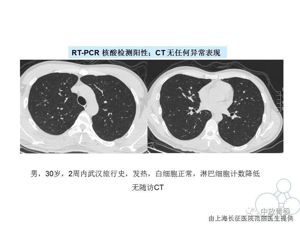 【PPT】COVID-19影像表现及研究进展