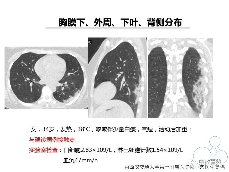 【PPT】COVID-19影像表现及研究进展