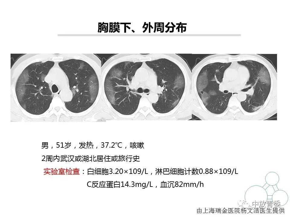 【PPT】COVID-19影像表现及研究进展