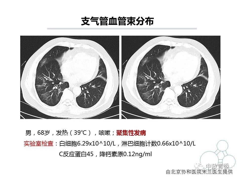 【PPT】COVID-19影像表现及研究进展