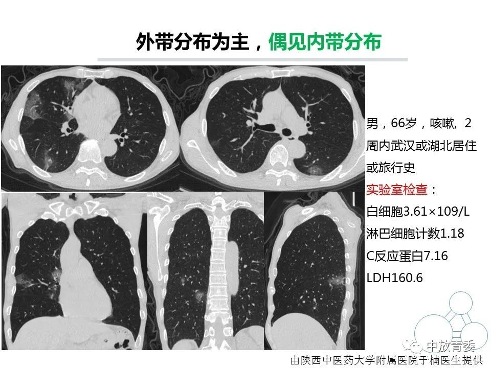 【PPT】COVID-19影像表现及研究进展