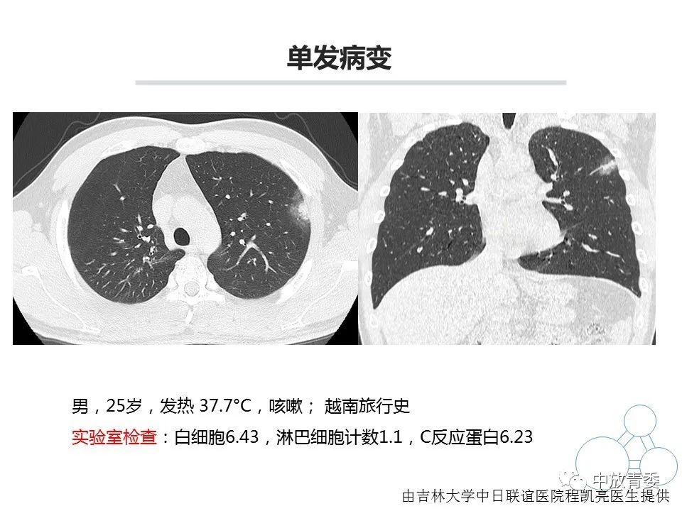 【PPT】COVID-19影像表现及研究进展