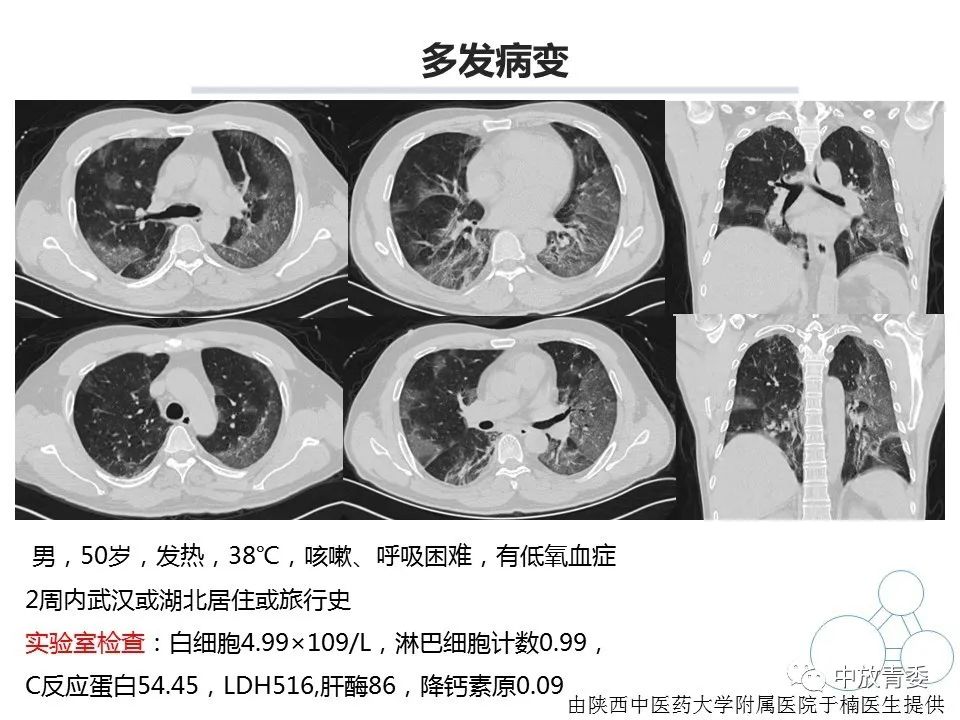 【PPT】COVID-19影像表现及研究进展