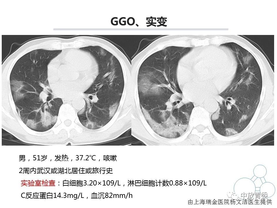 【PPT】COVID-19影像表现及研究进展