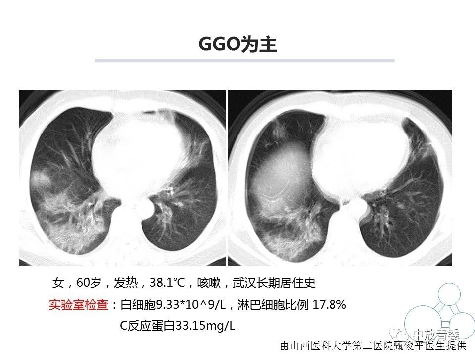 【PPT】COVID-19影像表现及研究进展