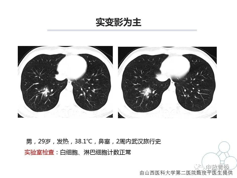 【PPT】COVID-19影像表现及研究进展