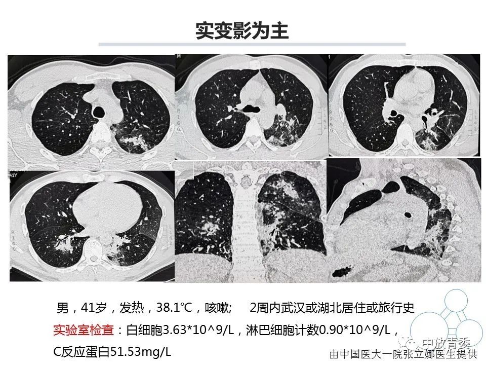 【PPT】COVID-19影像表现及研究进展