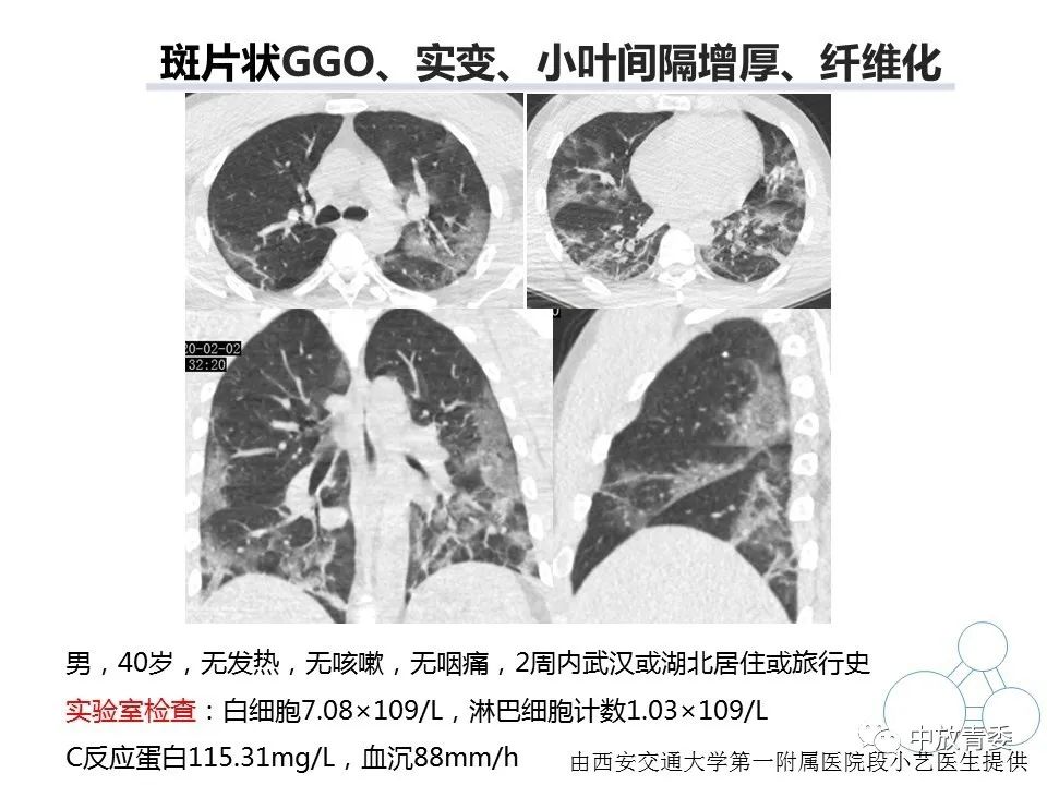【PPT】COVID-19影像表现及研究进展