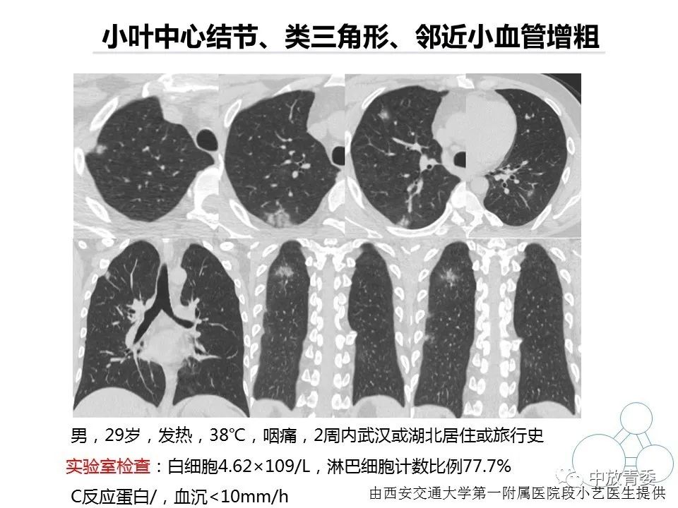 【PPT】COVID-19影像表现及研究进展