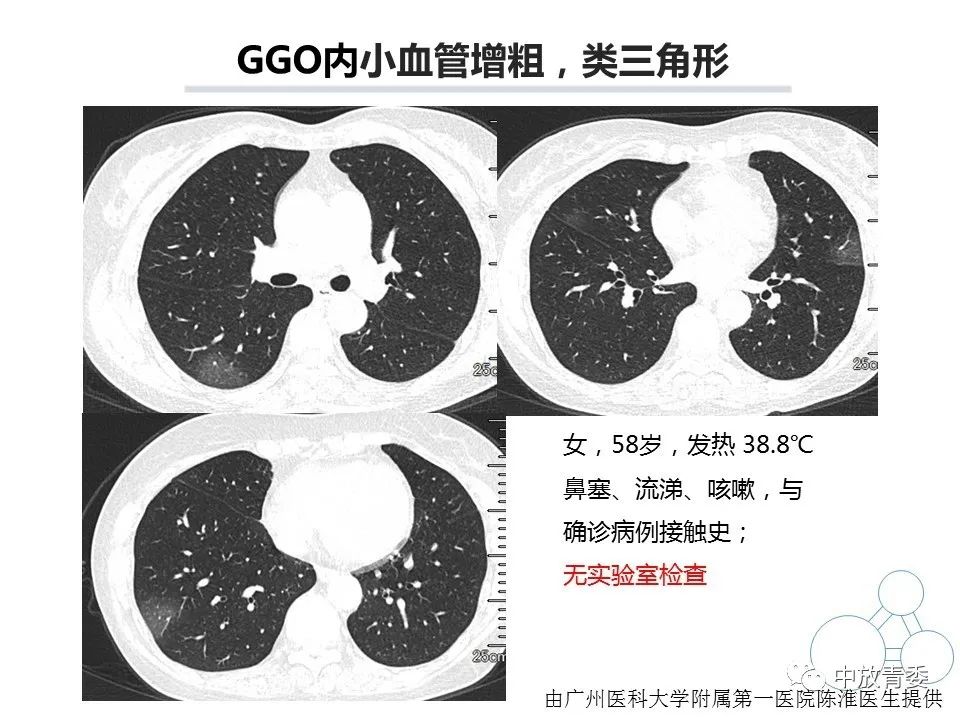 【PPT】COVID-19影像表现及研究进展