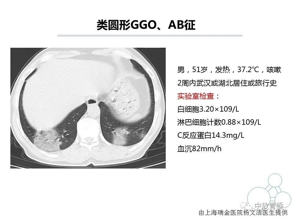 【PPT】COVID-19影像表现及研究进展