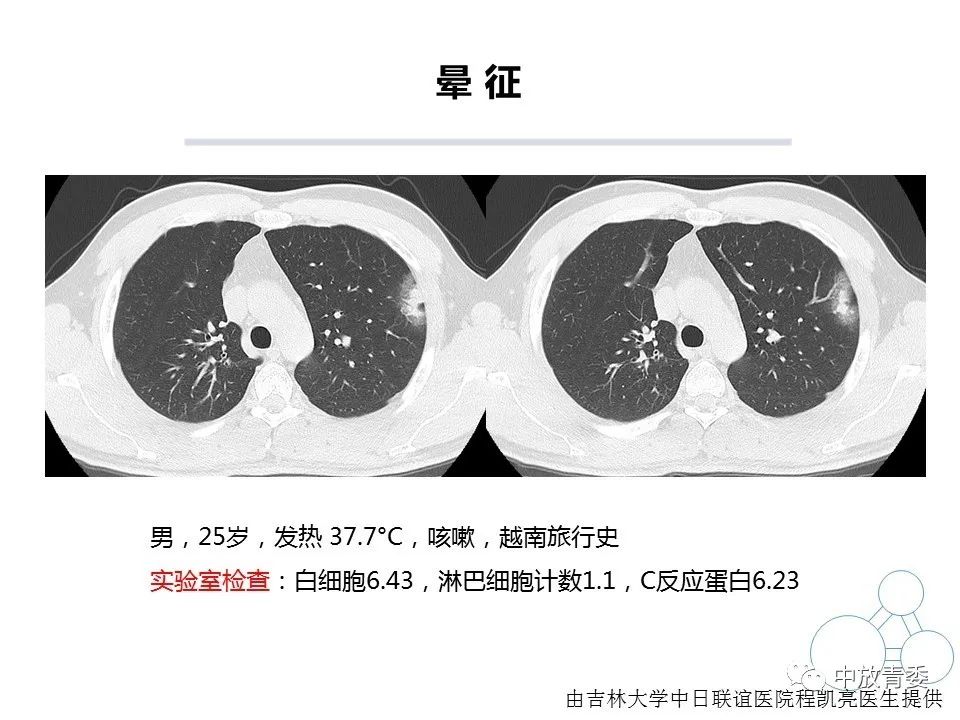 【PPT】COVID-19影像表现及研究进展