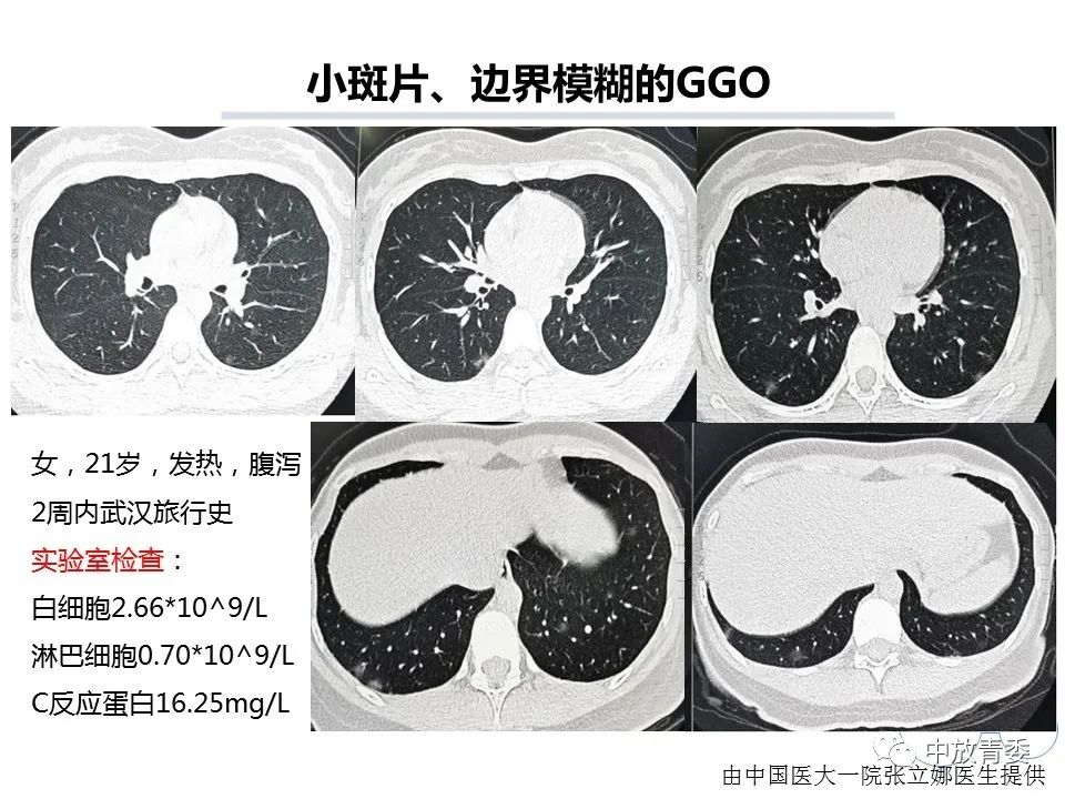 【PPT】COVID-19影像表现及研究进展