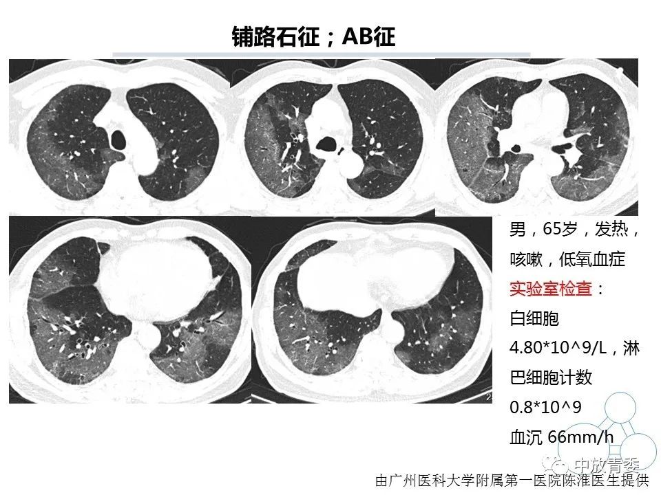 【PPT】COVID-19影像表现及研究进展
