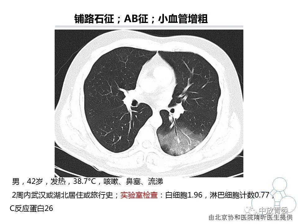 【PPT】COVID-19影像表现及研究进展