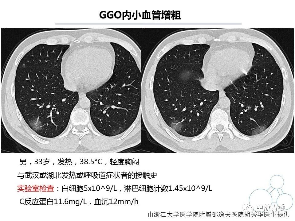 【PPT】COVID-19影像表现及研究进展