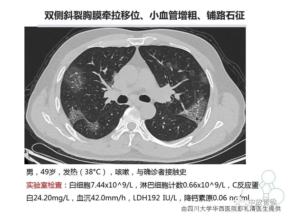 【PPT】COVID-19影像表现及研究进展