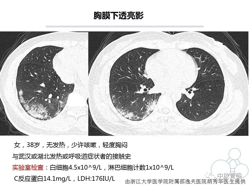 【PPT】COVID-19影像表现及研究进展