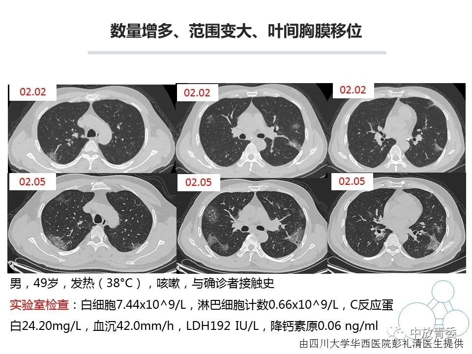 【PPT】COVID-19影像表现及研究进展