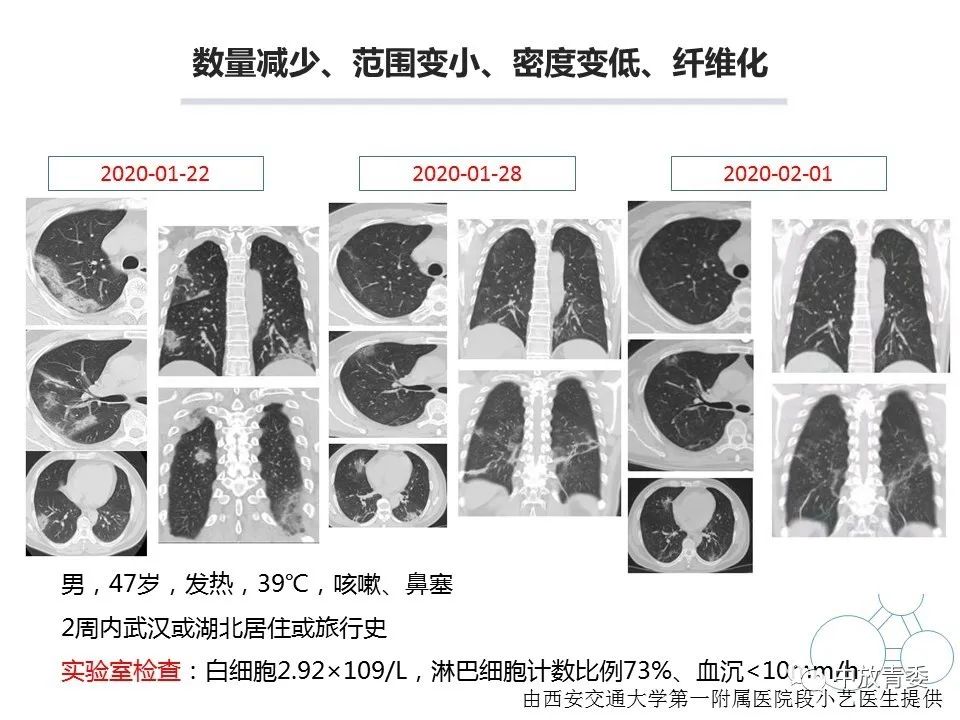 【PPT】COVID-19影像表现及研究进展