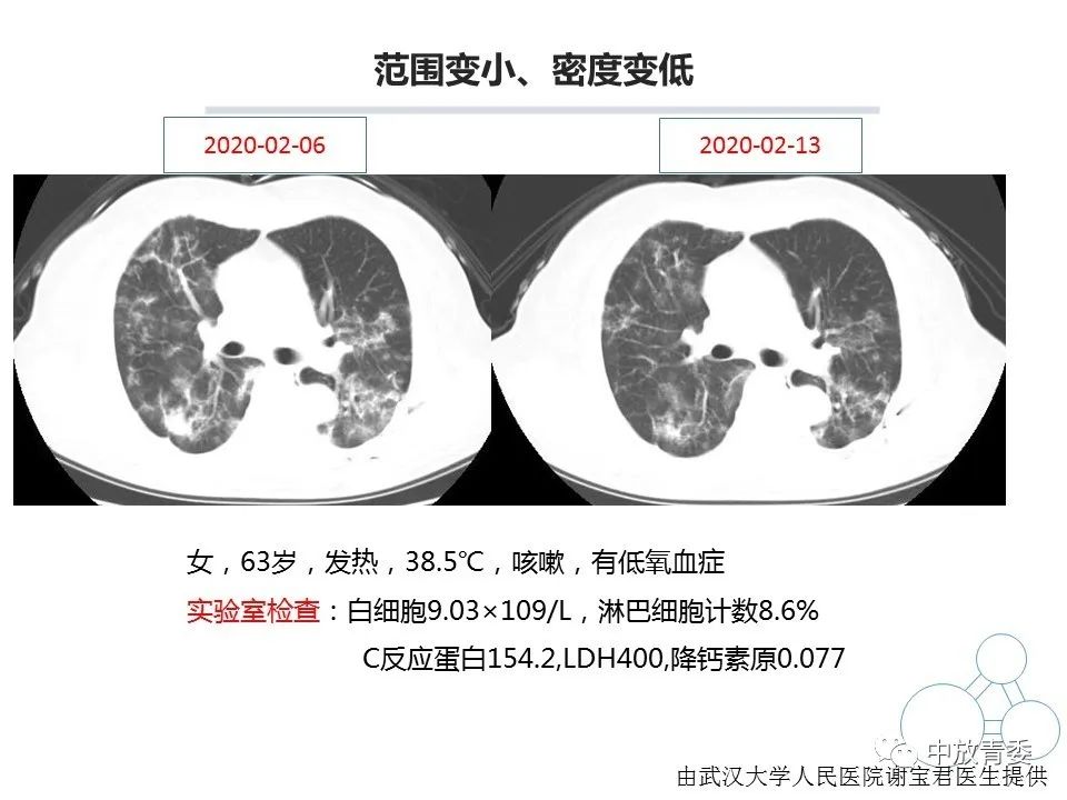 【PPT】COVID-19影像表现及研究进展