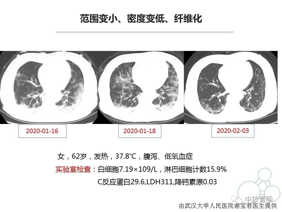 【PPT】COVID-19影像表现及研究进展