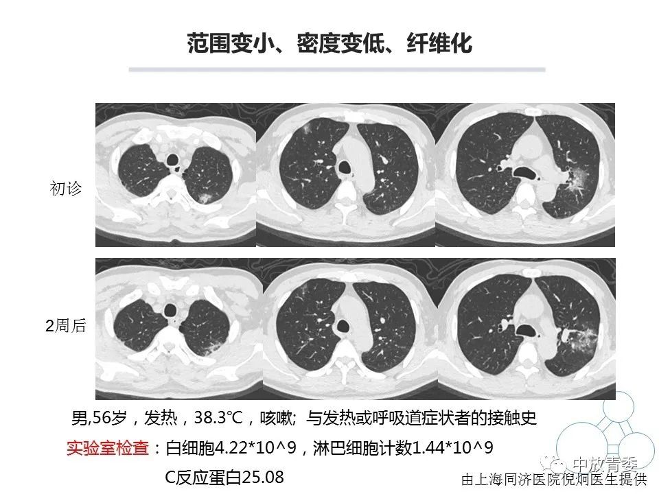 【PPT】COVID-19影像表现及研究进展