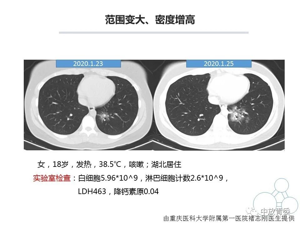 【PPT】COVID-19影像表现及研究进展