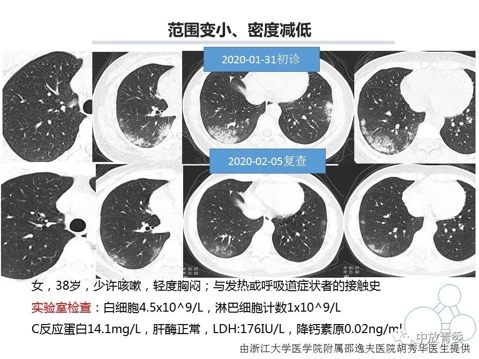 【PPT】COVID-19影像表现及研究进展