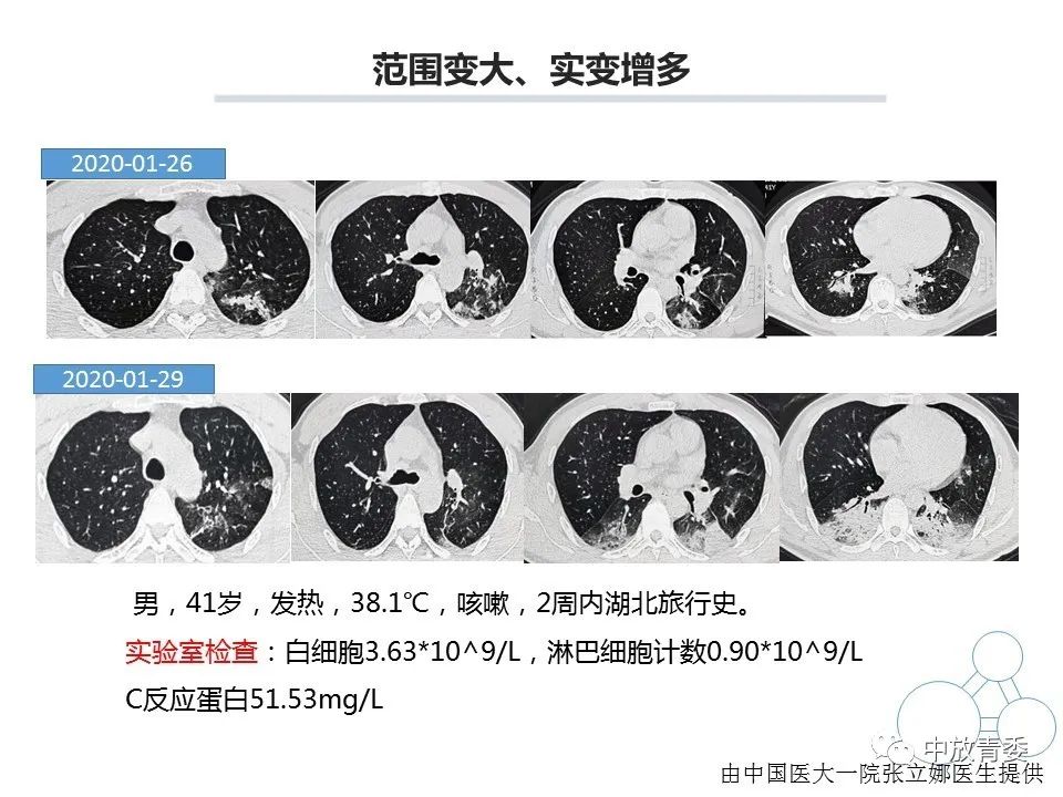 【PPT】COVID-19影像表现及研究进展