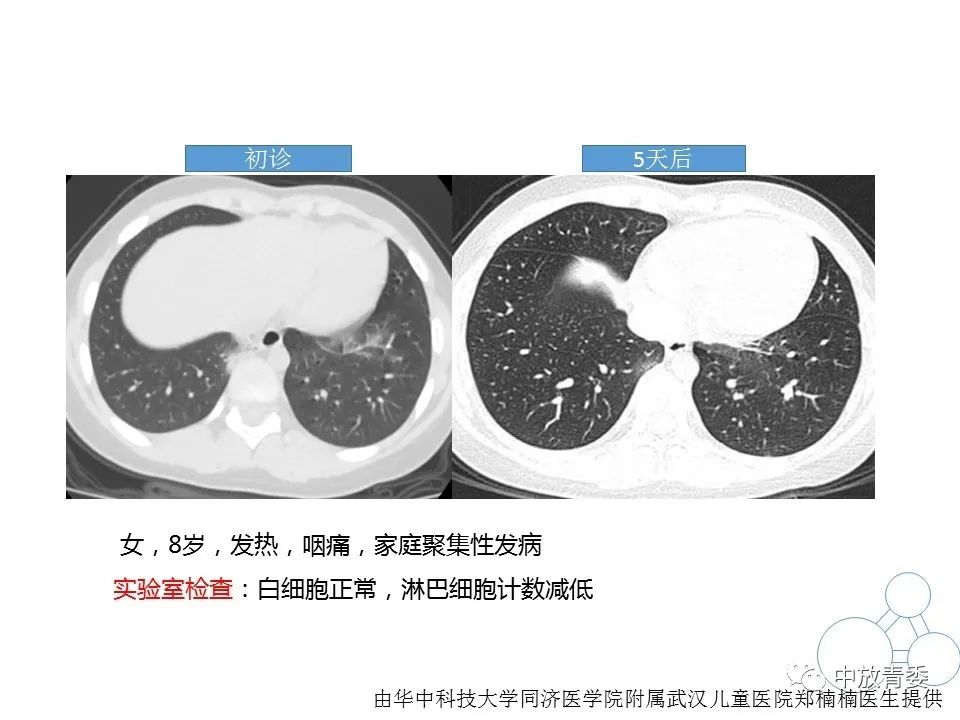 【PPT】COVID-19影像表现及研究进展
