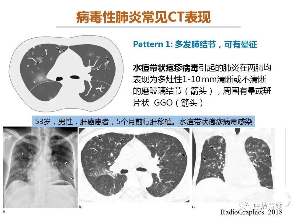 【PPT】COVID-19影像表现及研究进展