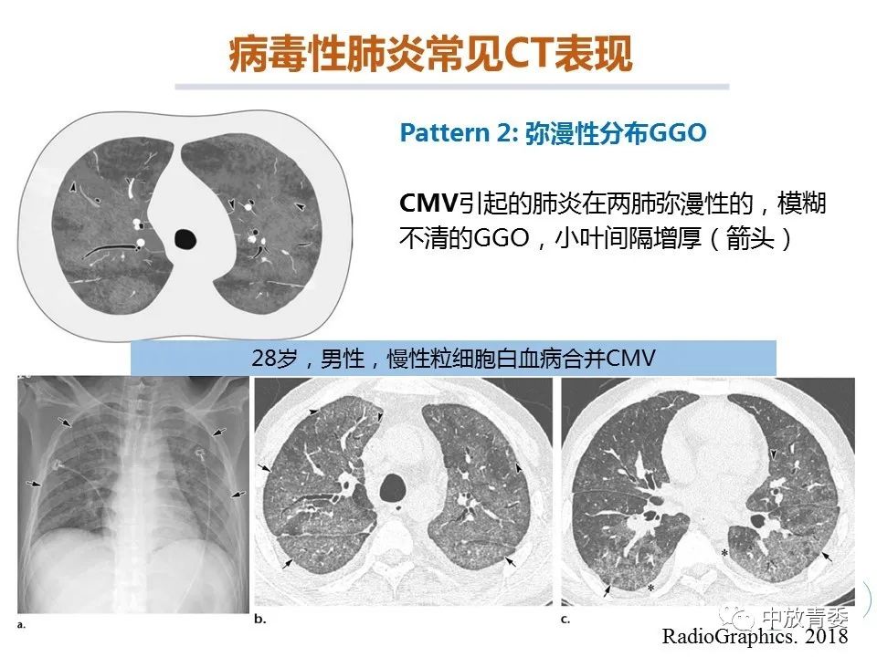 【PPT】COVID-19影像表现及研究进展