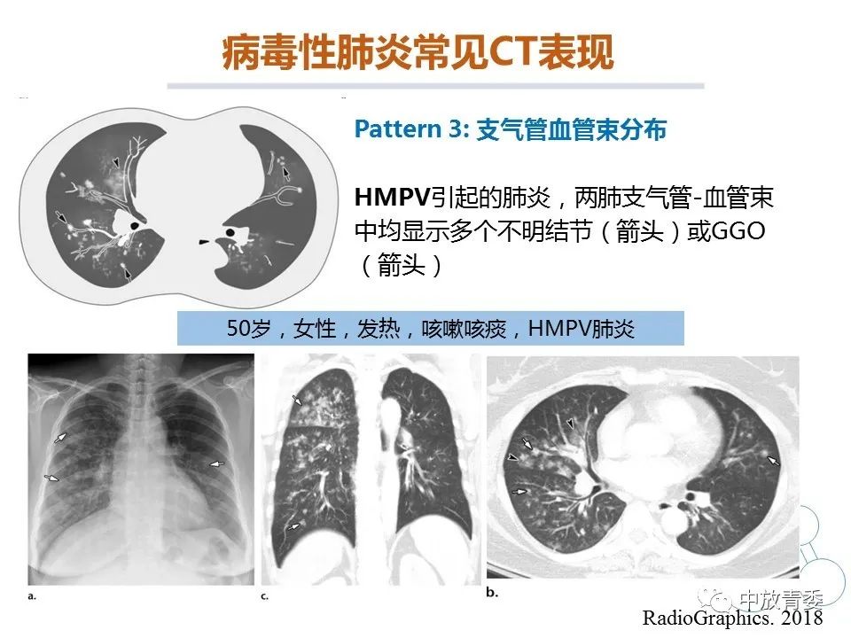 【PPT】COVID-19影像表现及研究进展