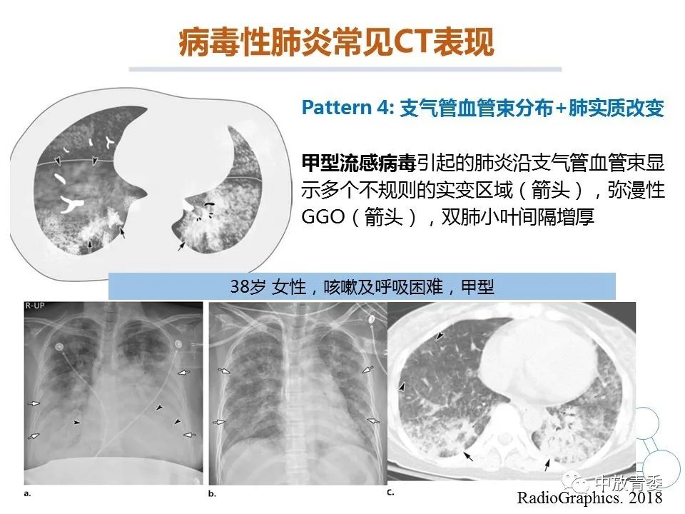 【PPT】COVID-19影像表现及研究进展