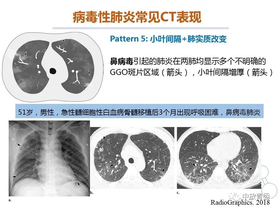【PPT】COVID-19影像表现及研究进展