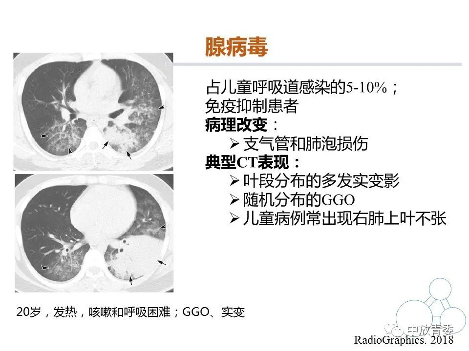 【PPT】COVID-19影像表现及研究进展