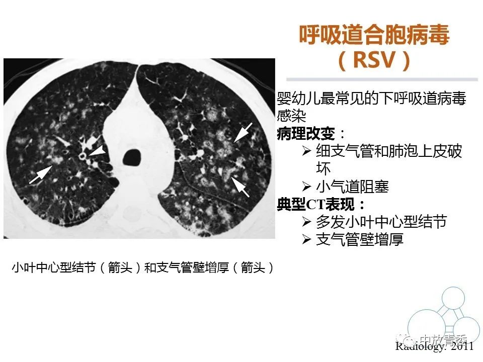 【PPT】COVID-19影像表现及研究进展