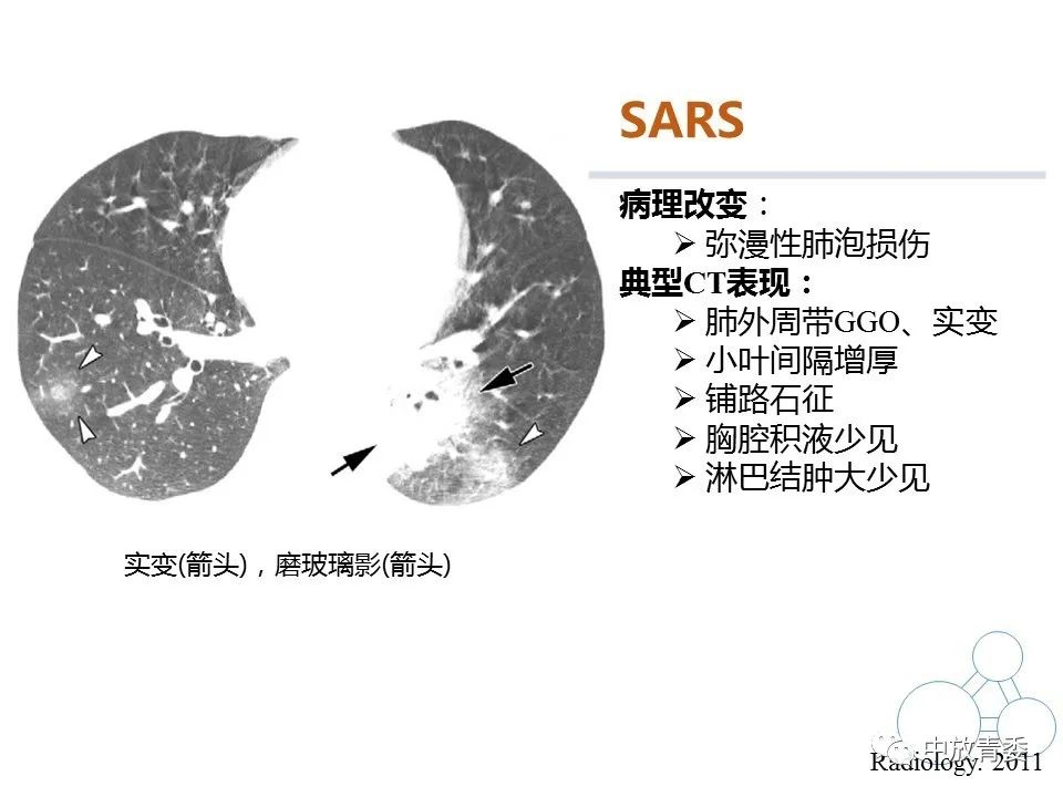 【PPT】COVID-19影像表现及研究进展